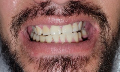 patient before whitening