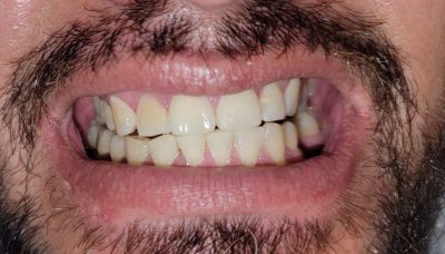 patient before whitening