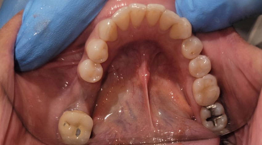 patient mouth before dental implant