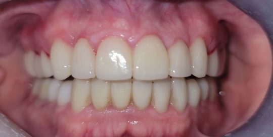 John-Doe-after-1-featured-image